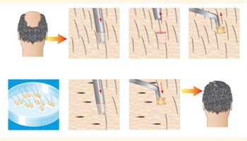 fue-method fue-method