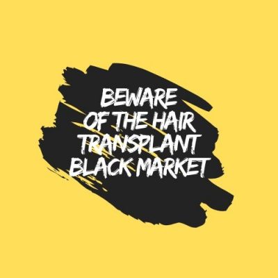 beware-of-the-hair-transplant-black-market