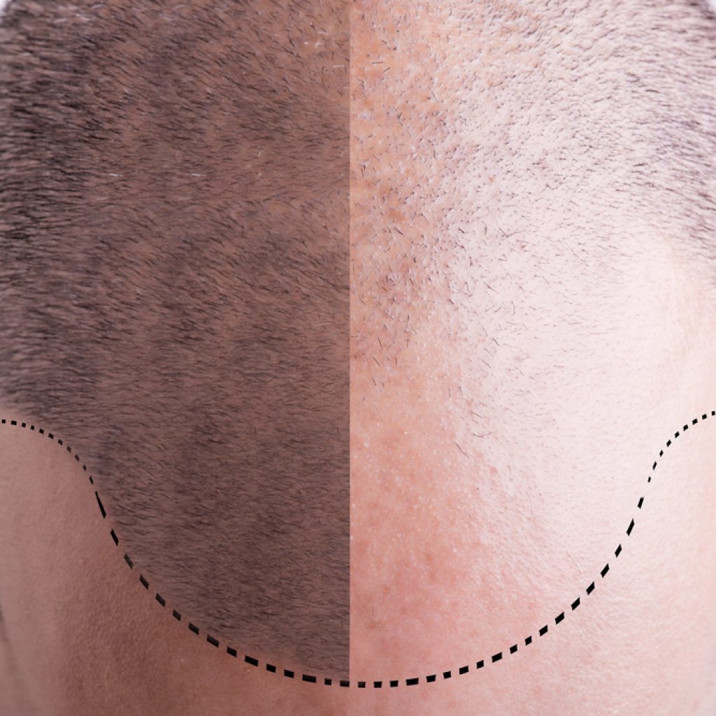 hair loss surgeries