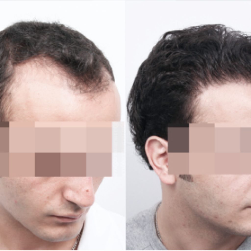 hair transplant in Turkey Before After