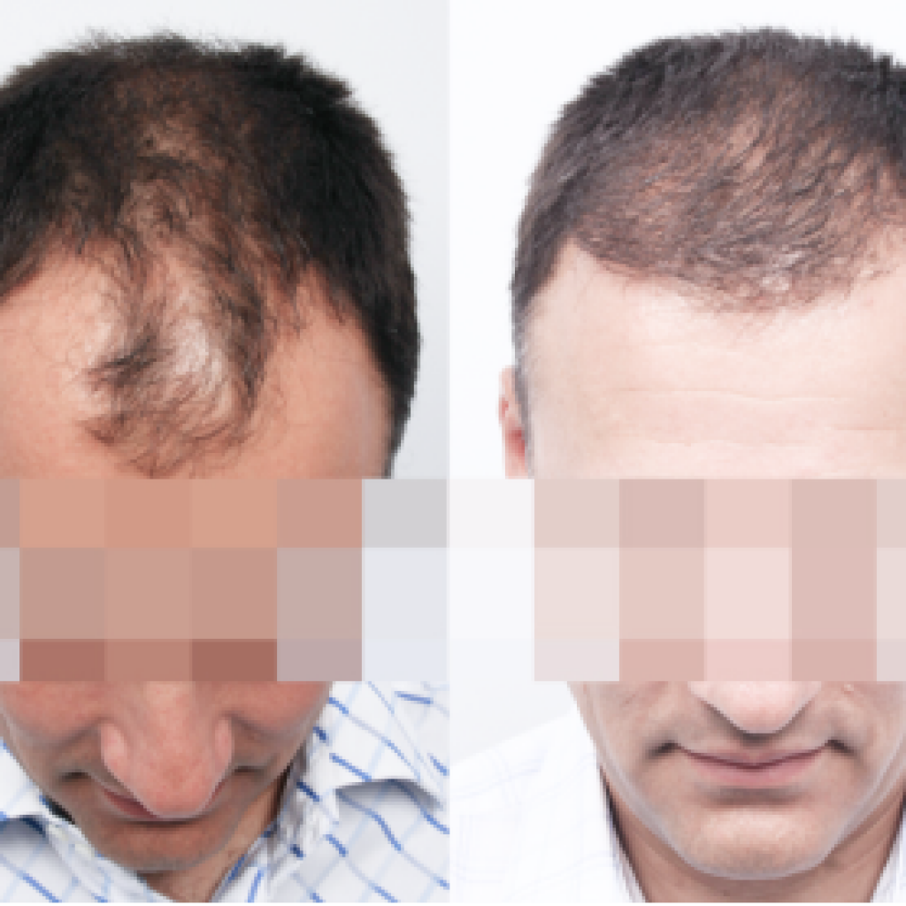Before After Photo of hair transplant in Turkey