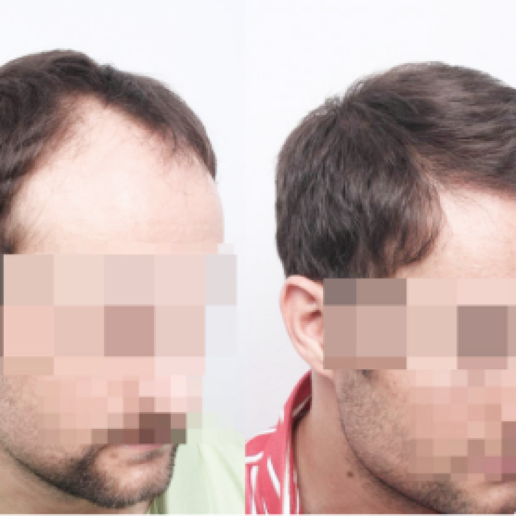 Before After Picture of hair transplant in Turkey