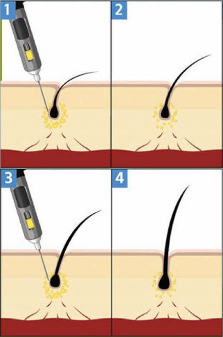 how does prp work