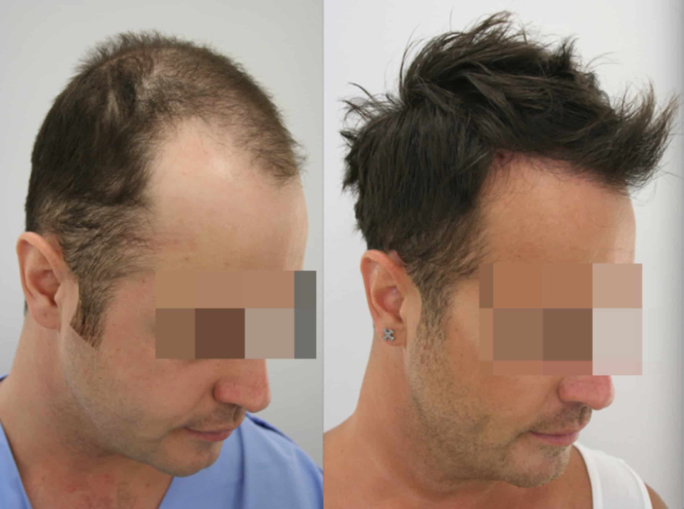 How much does a hair transplant cost - UK / London / Hungary / Turkey