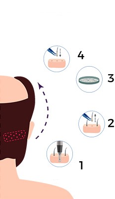 fue hair transplant process