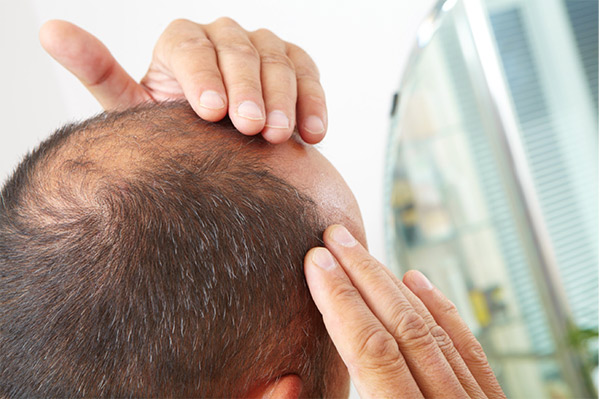 cost of hair transplants, hair loss