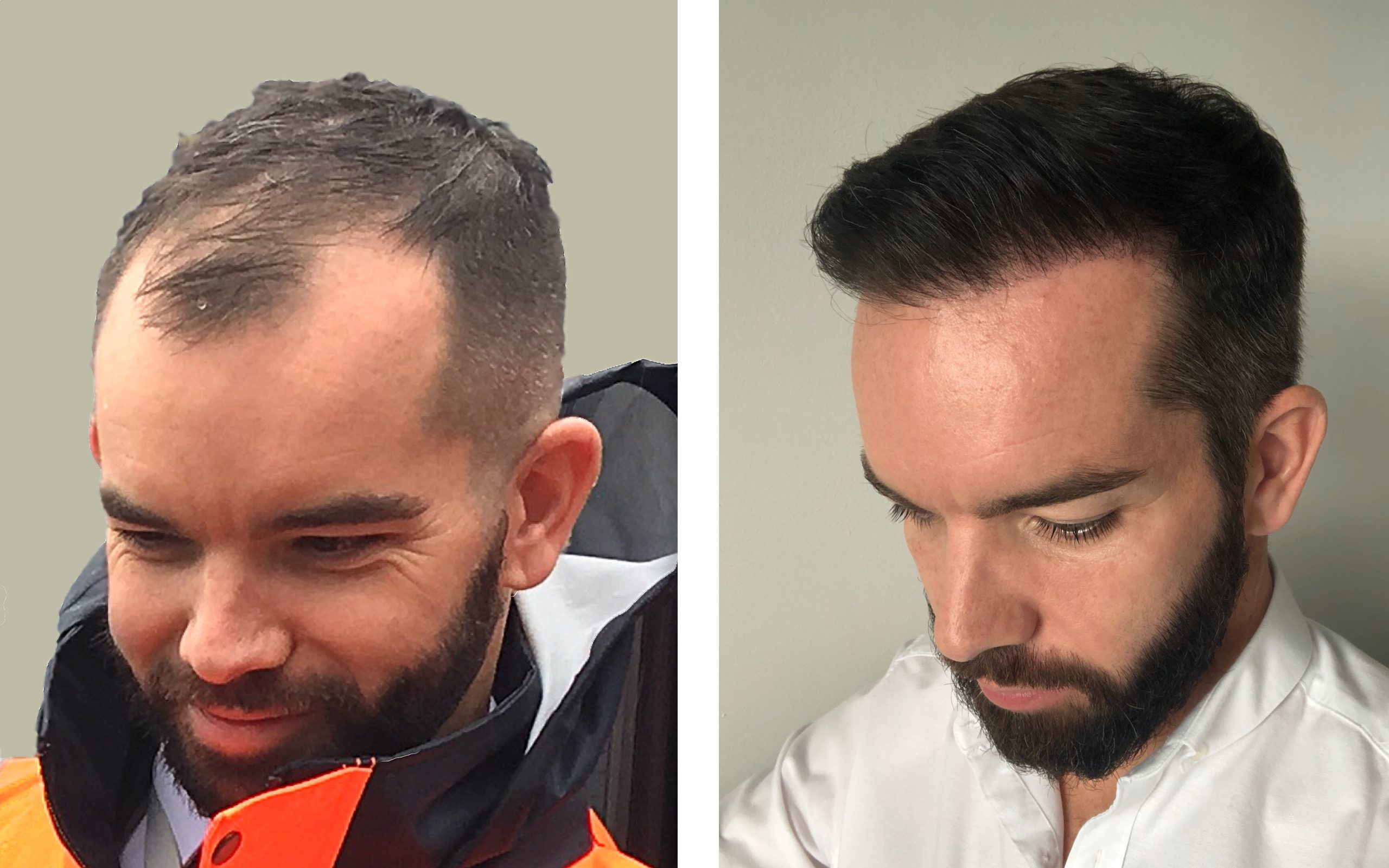 hair transplant before after