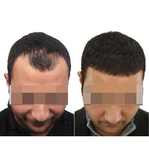2000 grafts
