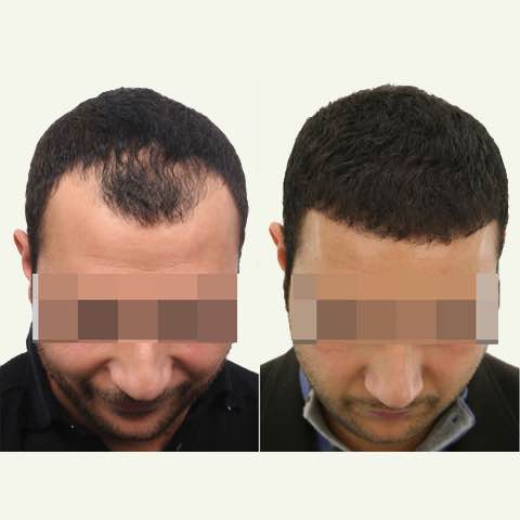 what is the average turkey hair transplant cost?