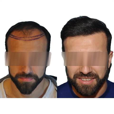 2500 grafts