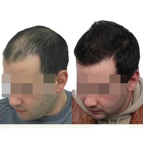 3000 grafts