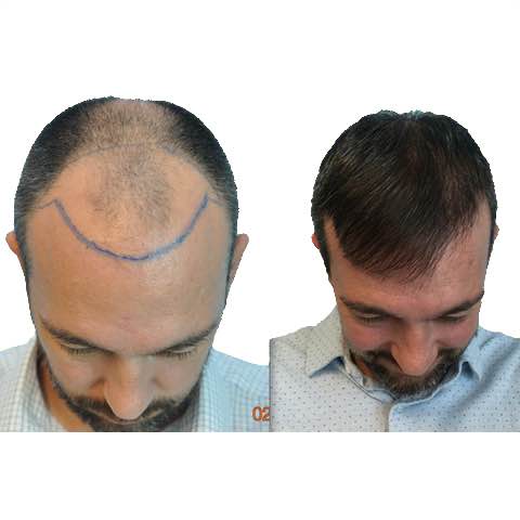 hair transplant before after photos 3500 grafts