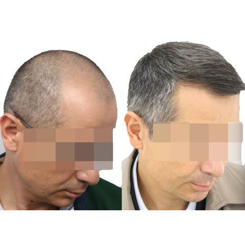 4000 grafts