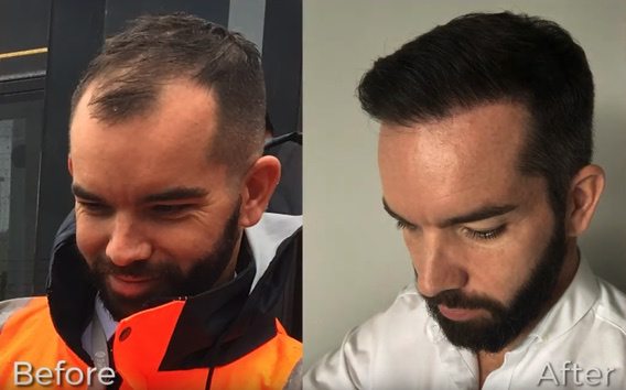 hair transplant before after photos