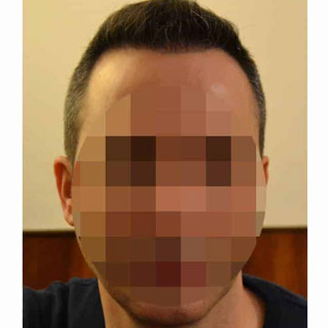 where to look for the best hair transplant in Turkey