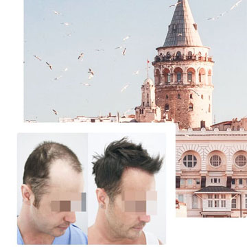 who offers the best Turkey hair transplant 