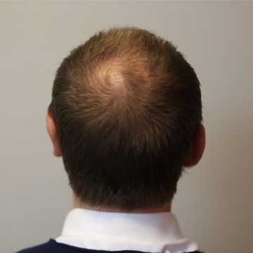 how to find the best Turkish hair transplant clinic online