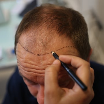 what is the best Turkish hair transplant clinic