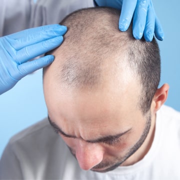 where to check the hair transplant cost in Turkey