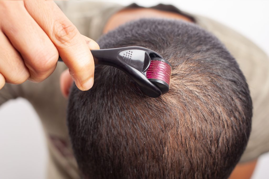 microneedling and dermaroller for hair growth