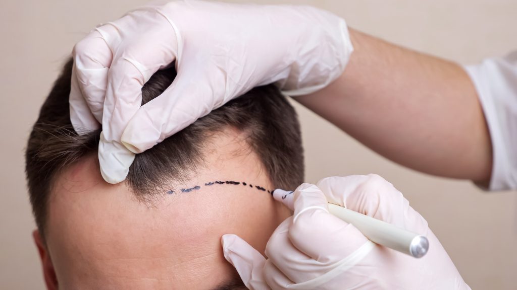 Does a Hair Transplant Have the Potential to Fail?