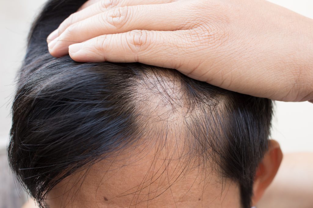 The Role of DHT in Hair Loss