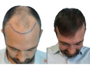 hair transplant before after photos 3500 grafts