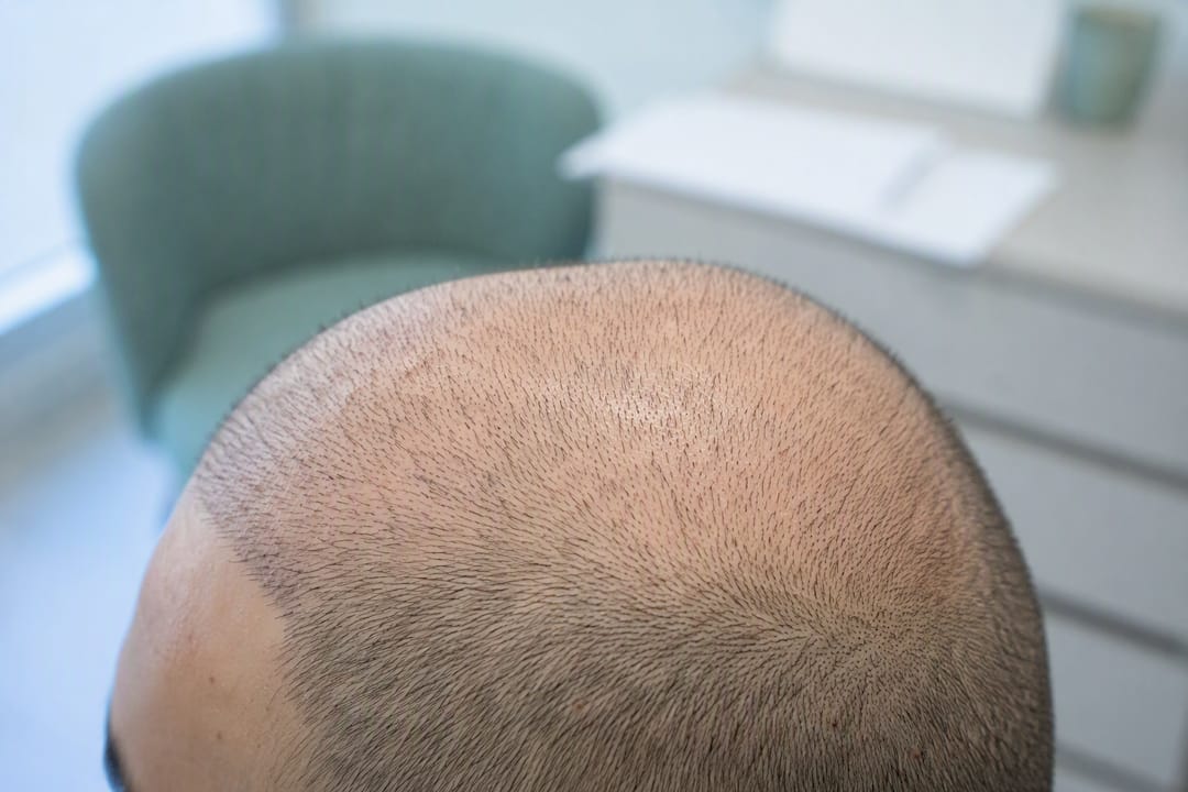 Early straight hair regrowth on scalp after transplant