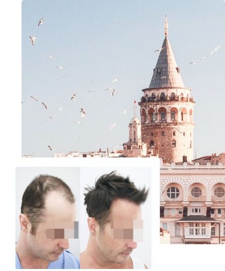 why hair transplant cheaper in turkey